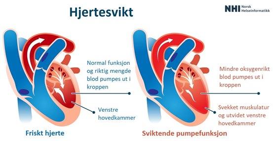 Illustrasjon som viser endringer i hjertets pumpefunksjon ved svikt