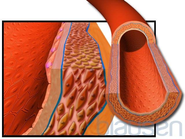 Arterie