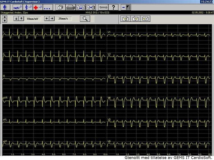 Pacemaker