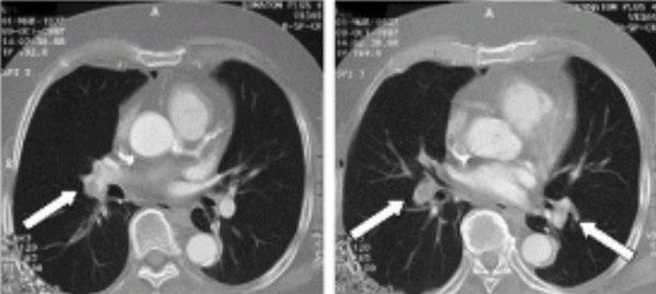 lungeemboli_Spiral CT