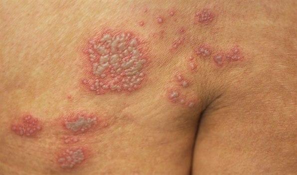 Shingles