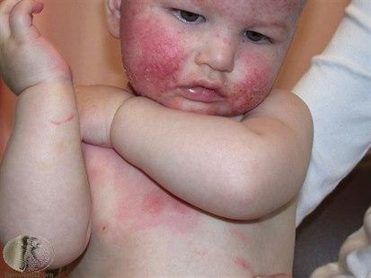 Naken baby (overkropp) med kraftig atopisk eksem i kinn og på brystet