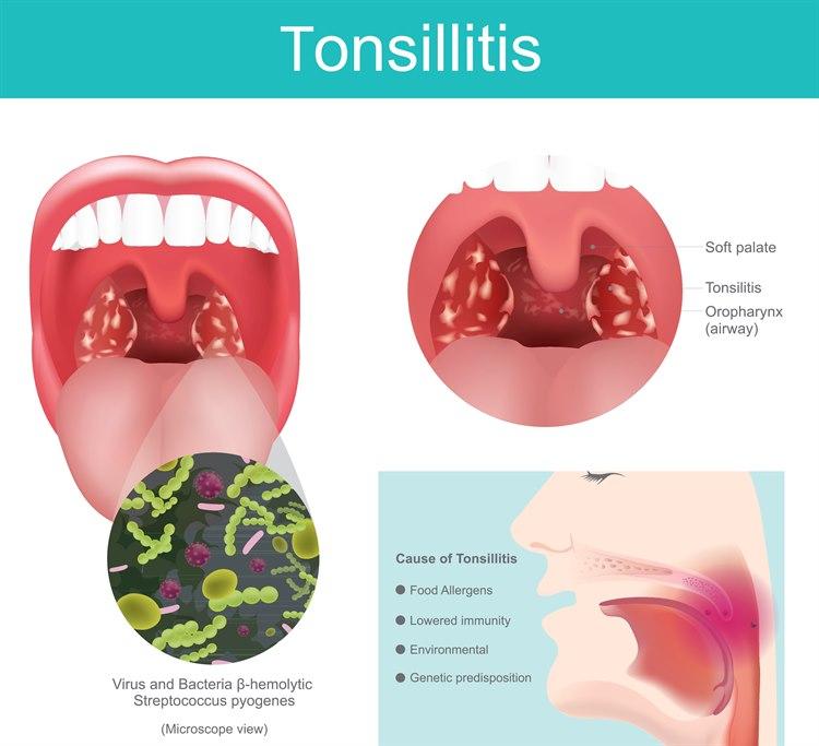 Tonsillitt.jpg