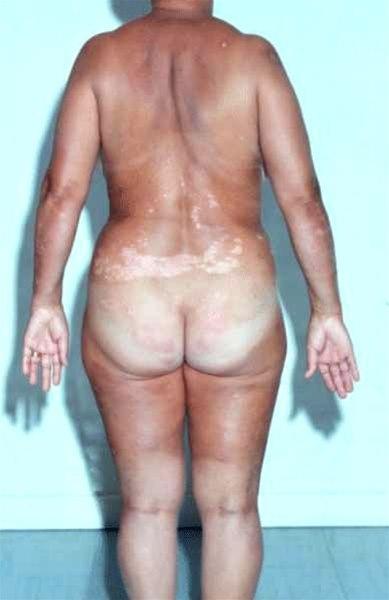 Psoriasis, rygg, mild