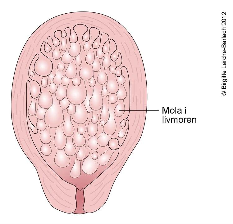 Blæremola