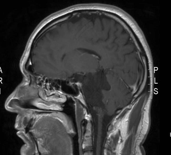 epidermoid tumor 2