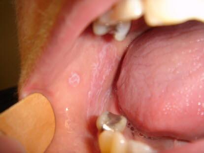 Lichen planus munn