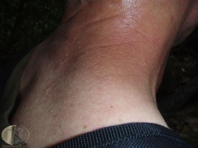 Fotoet viser hyperhidrose