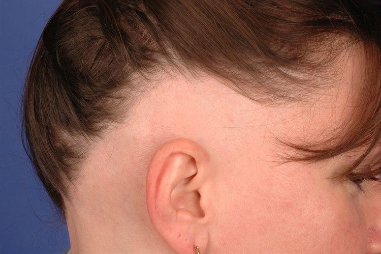 4791-2-alopesia-areata.jpg
