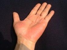 Palmar erythem