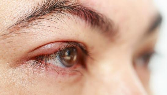 Blepharitis