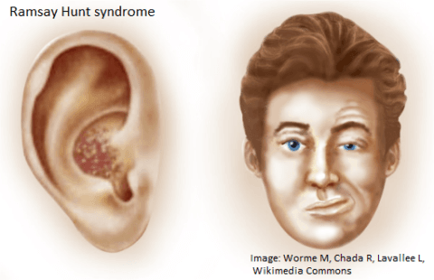 Ramsay Hunt Syndrome