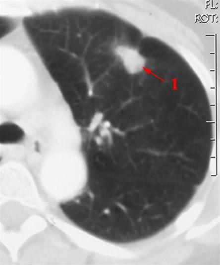 Lungecancer (CT)