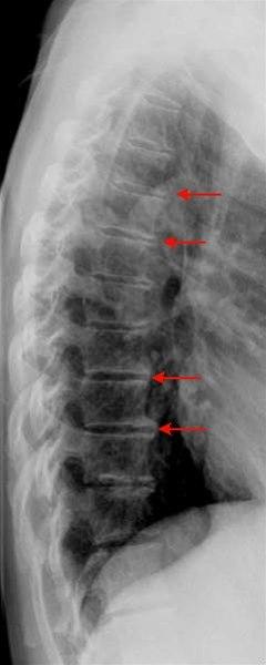 Spondylose