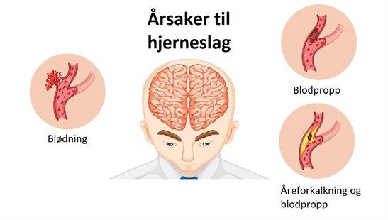 Årsaker til slag