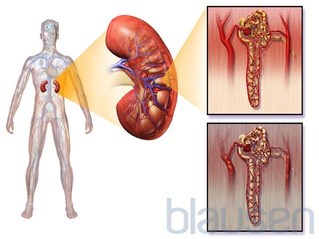 Diabetes nefropati