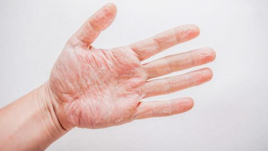 hand eczema