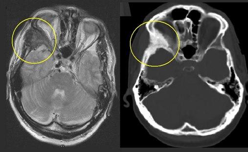 Fibrous dysplasia of the bone