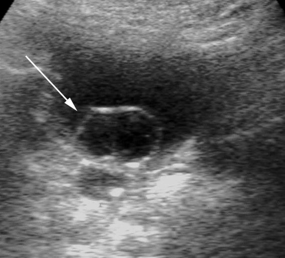 Ureterocele (UL)