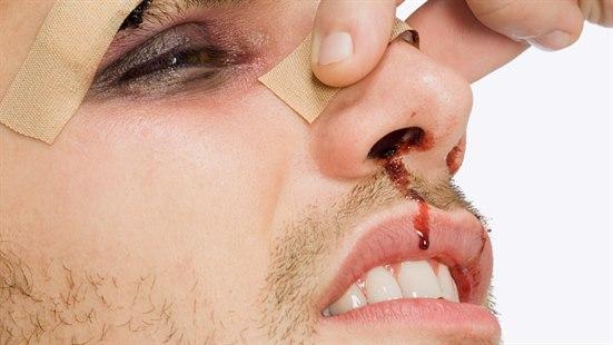 Illustrasjonsfoto av en skadet mann med plaster over øyenbrynet og nesen. Han har blått øye, og blod renner ned fra nesen.