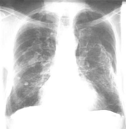 Asbestose