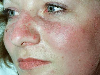 Systemic lupus erythematosus (SLE)