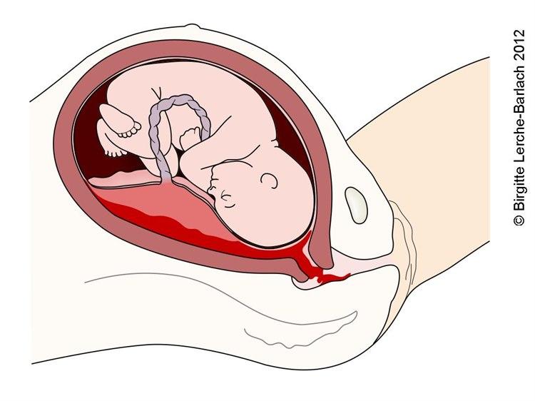 Gravid med stort foster