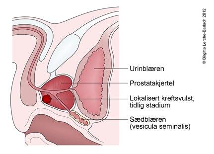 Prostatakreft