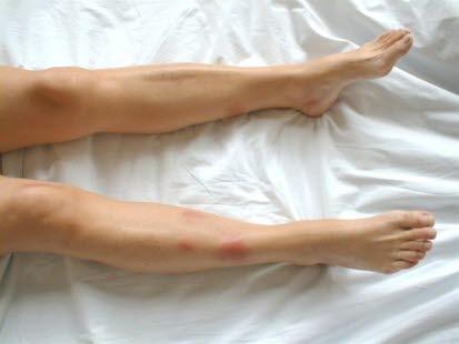 Erythema nodosum2