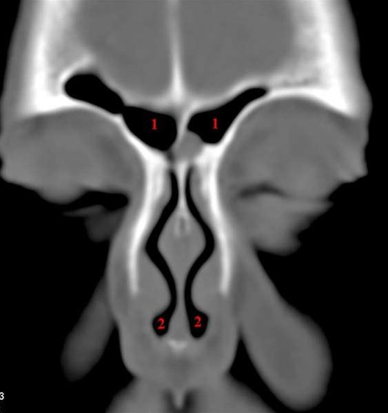 Frontalsinus, coronal