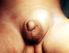 Inguinalhernie 2