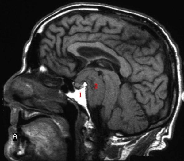 Meningiom