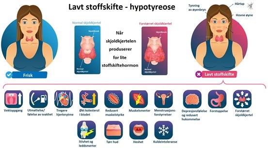 Hypothyroidism