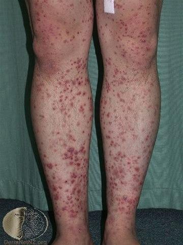 Purpura