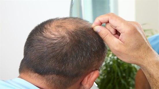 Alopeci