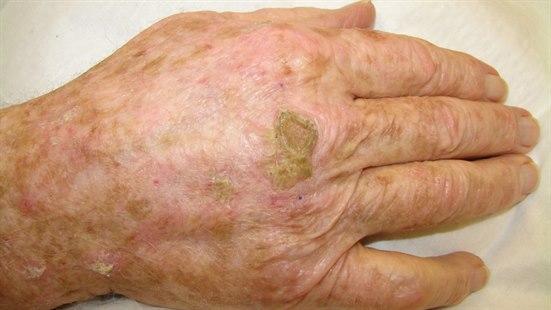 Actinic keratosis