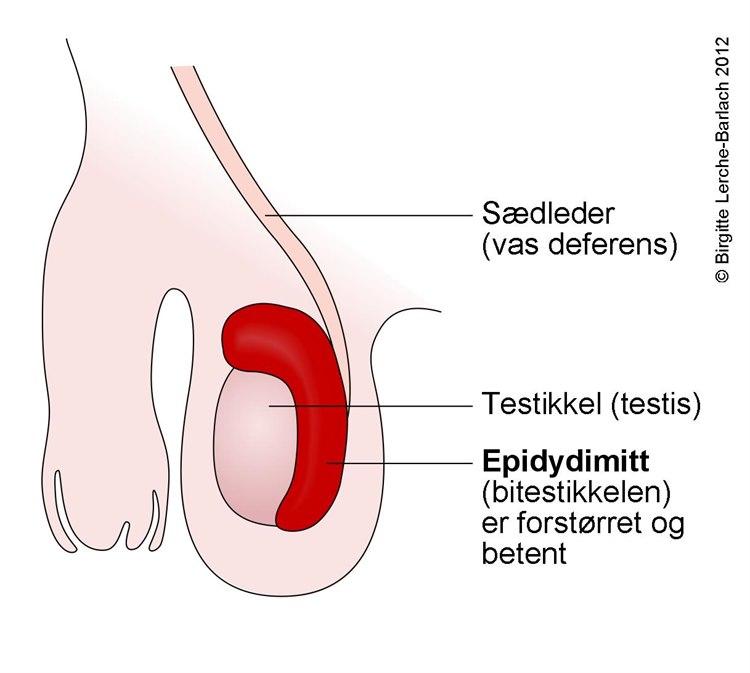 Scrotum - epididymitt