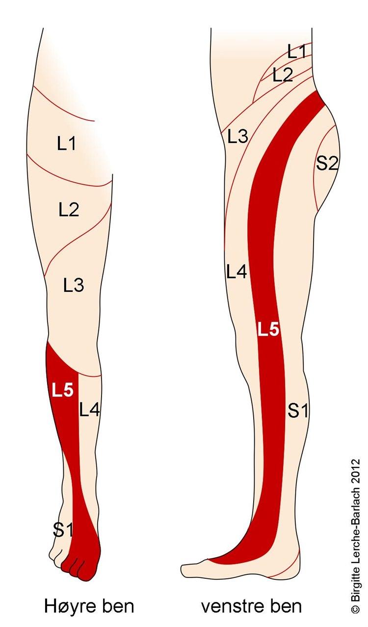 Dermatom L5
