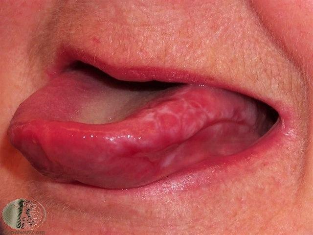 Fotoet viser oral lichen planus