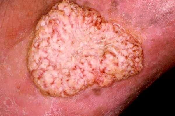 Skiveepitelcancer