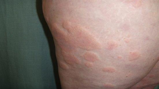 Hives