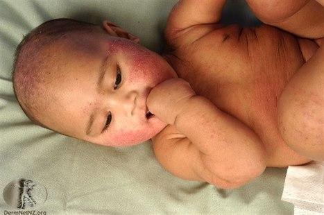 Foto av naken baby hode og overkropp. Babyen har eksem i ansikt, på kropp, armer og ben.