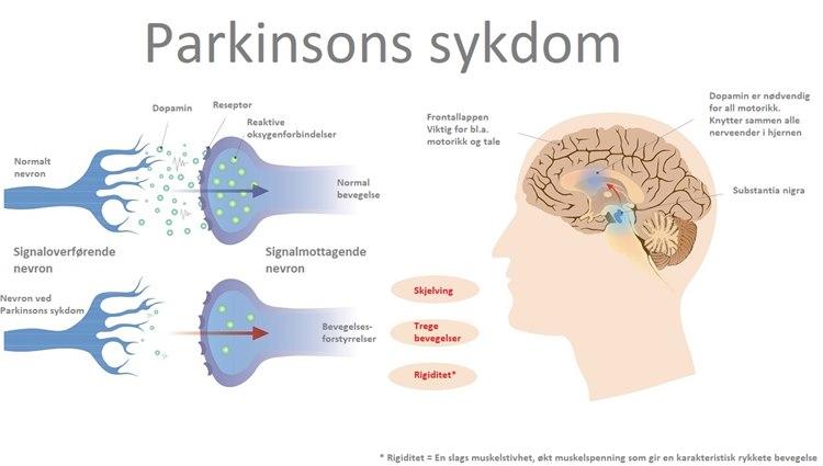 Parkinsons disease.jpg