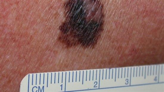 Superficial spreading melanoma