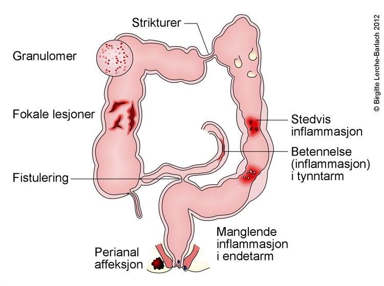 Kjennetegn på Crohns sykdom