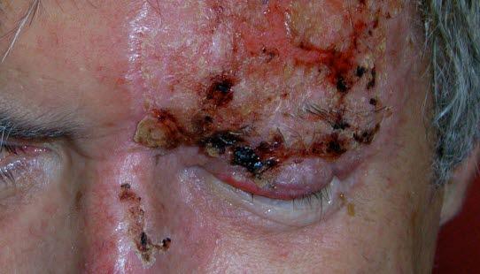 herpes zoster