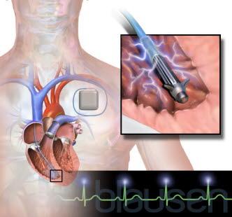 ICD - Implanetable Cardioveter Defibrillator