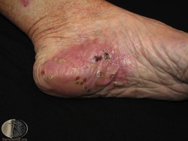Pustulosis palmoplantaris