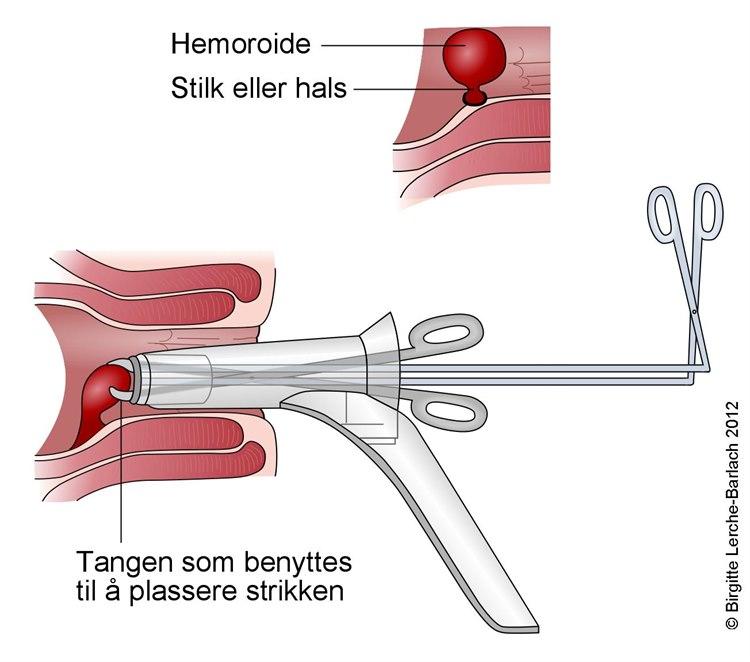 Fjerning av hemorroide