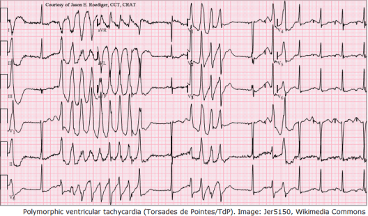 Polymorphic ventricular tachycardia